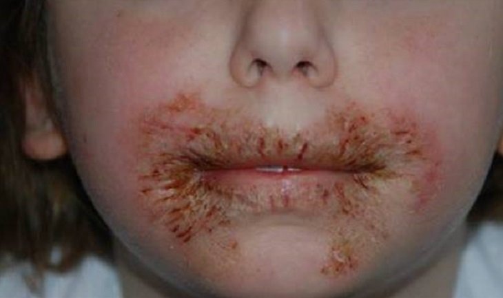 Врачи предупреждают: никогда не вытирайте кожу своих детей детскими влажными салфетками