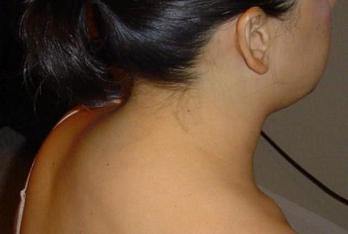 «Холка» — жировые отложения на шее. Как правильно избавиться от этих образований