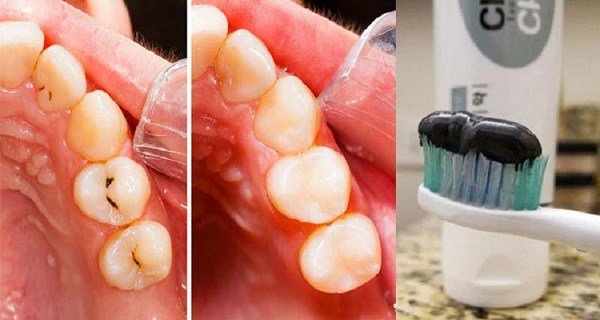 Эта зубная восстанавливает зубы. Стоматологи будут без работы