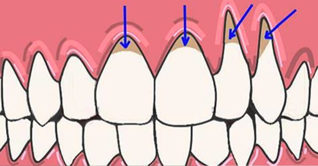 5 супер эффективных средства для устранения оголения шейки зуба и предотвращения потери зубов!