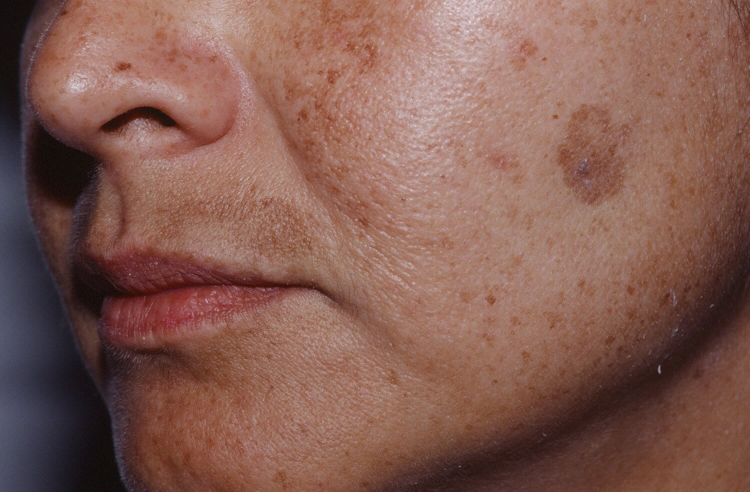 Известный дерматолог показал, с этим простым трюком вывести коричневые пятна на коже лица, стало гораздо легче