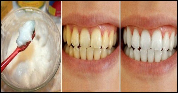 Отбеливайте зубы всего за 3 минуты, используя эти 2 натуральных ингредиента