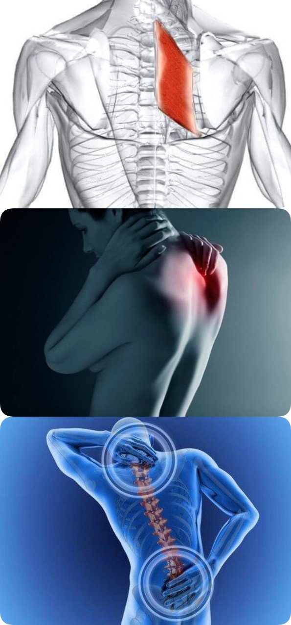 Ромбовидная мышца – возможная причина боли в области лопаток. Как устранить боль