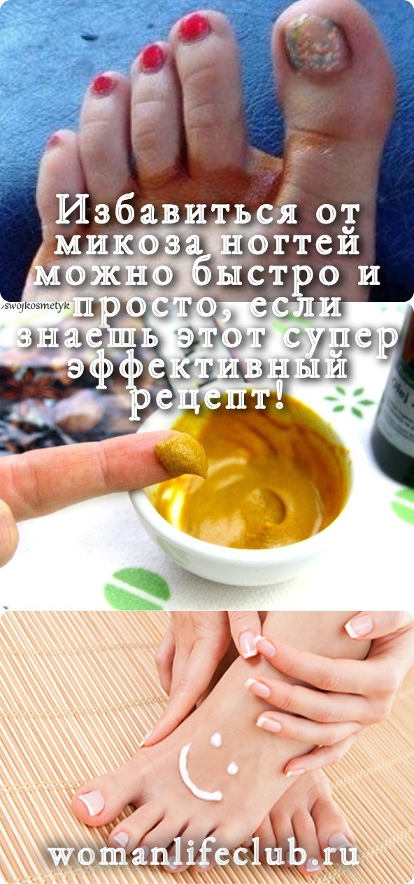 Избавиться от микоза ногтей можно быстро и просто, если знаешь этот супер эффективный рецепт!